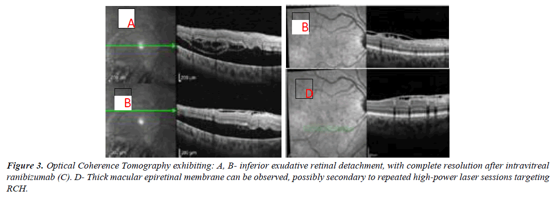 ophthalmic-and-eye-research-photocoagulated