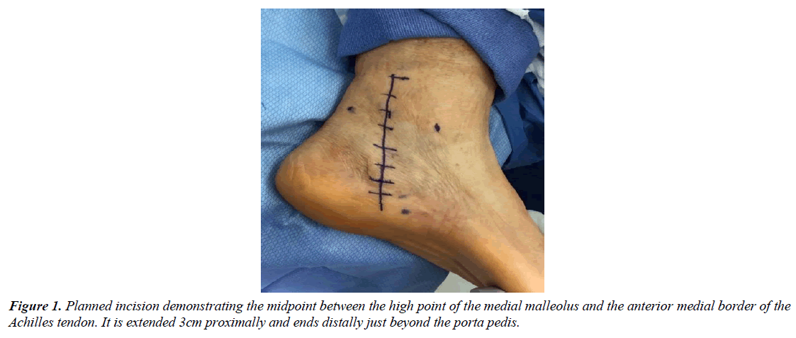 orthopedic-surgery-rehabilitation-achilles-tendon