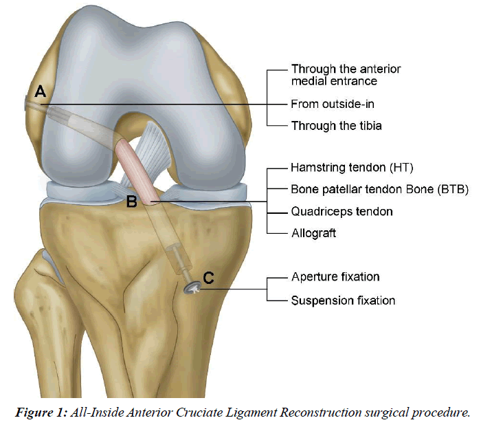 orthopedic-surgery-rehabilitation-cruciate-ligament