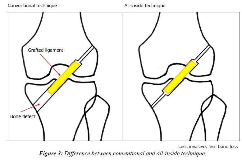 orthopedic-surgery-rehabilitation-cruciate-ligament