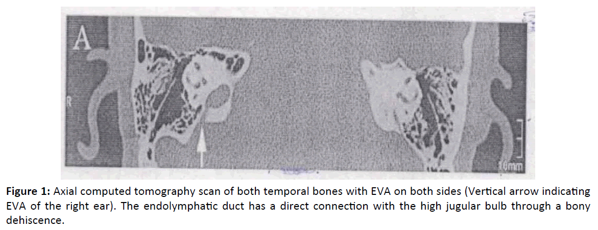 otolaryngology-online-journal-endolymphatic-duct