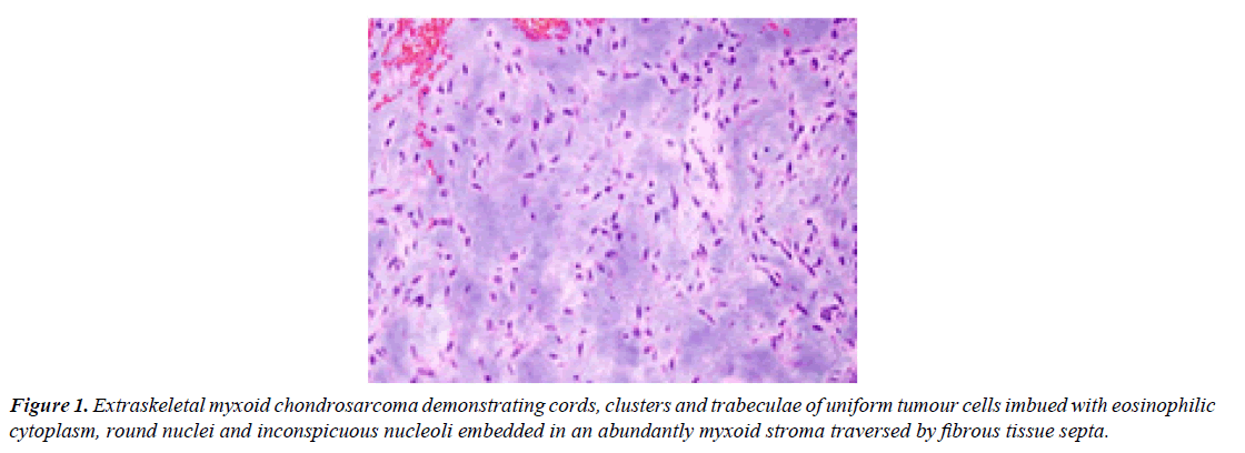 surgery-invasive-procedures-myxoid-chondrosarcoma