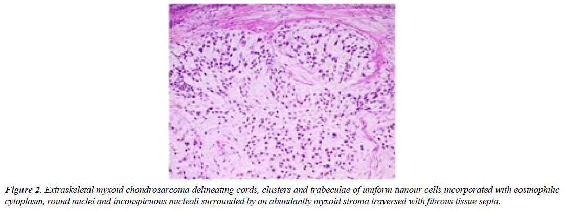 surgery-invasive-procedures-myxoid-chondrosarcoma