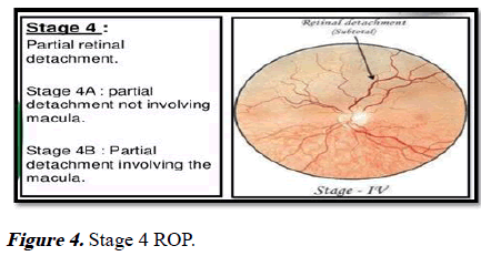Retinopathy of prematurity: Nurses persp | Biomedical Research