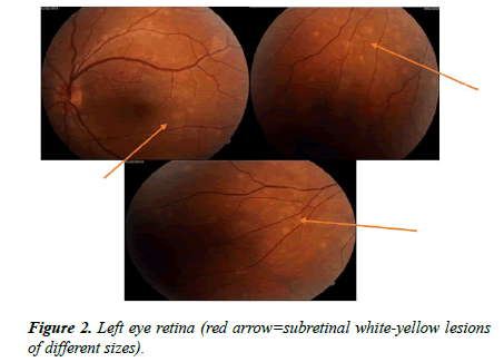 Ophthalmology-Case-Left-eye
