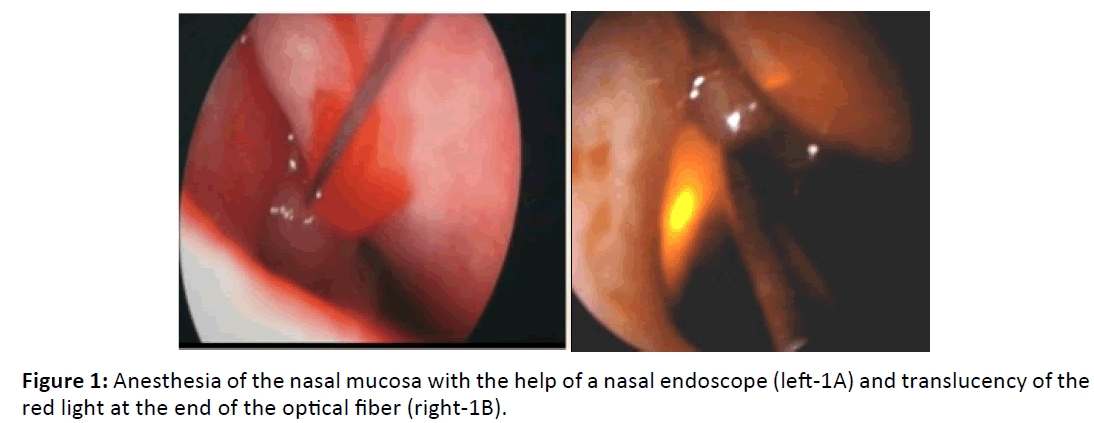 Otolaryngology-Anesthesia