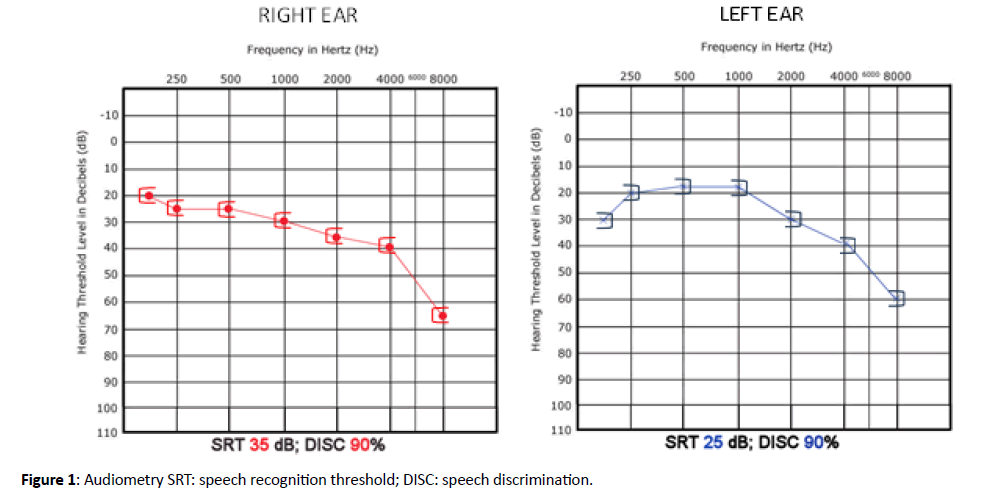 Otolaryngology-Audiometry