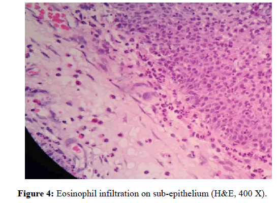 Otolaryngology-Eosinophil