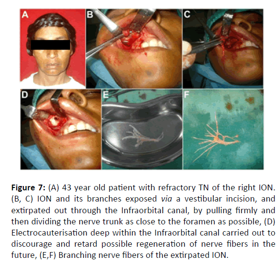 Otolaryngology-Infraorbital-canal