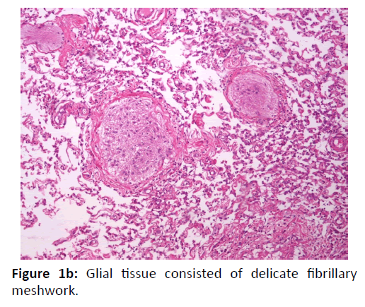 Otolaryngology-Nasal-Glial-tissue