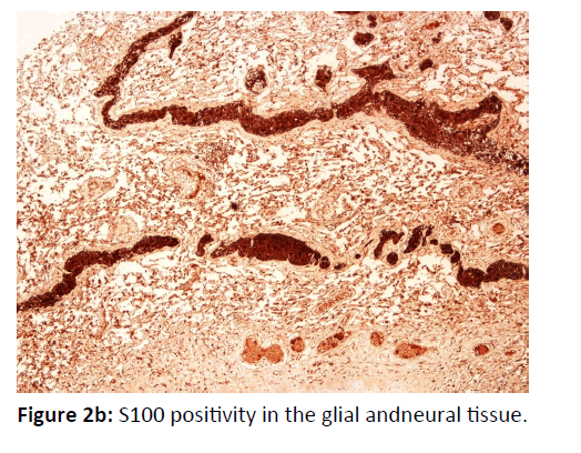 Otolaryngology-Nasal-glial-andneural