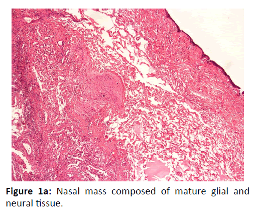 Otolaryngology-Nasal-mass-composed