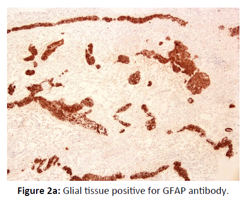 Otolaryngology-Nasal-tissue-positive