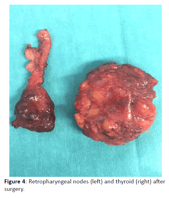 Otolaryngology-Retropharyngeal