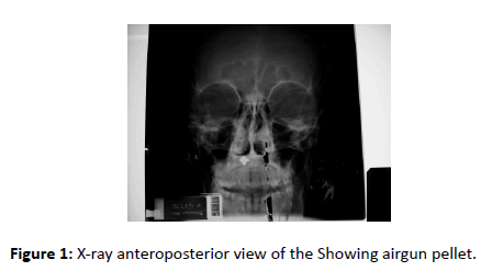 Otolaryngology-airgun-pellet