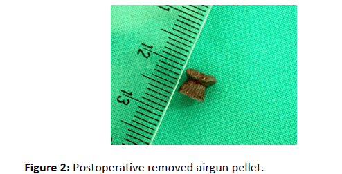 Otolaryngology-airgun-pellet