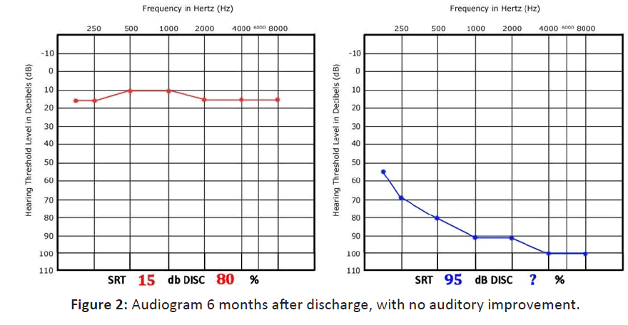 Otolaryngology-auditory