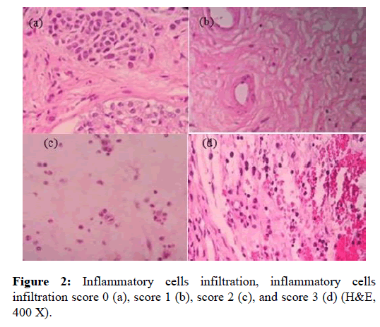 Otolaryngology-cells-infiltration