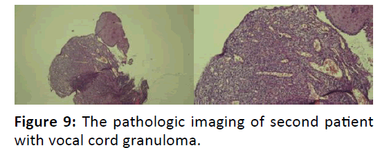 Otolaryngology-cord-granuloma