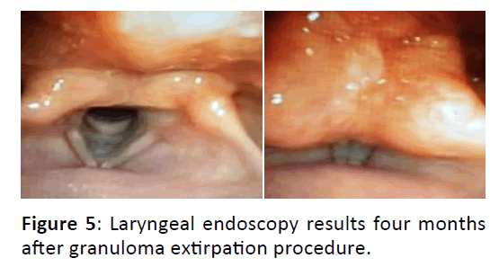 Otolaryngology-extirpation-procedure