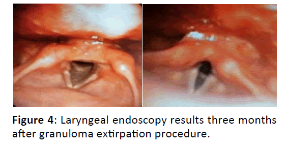 Otolaryngology-granuloma