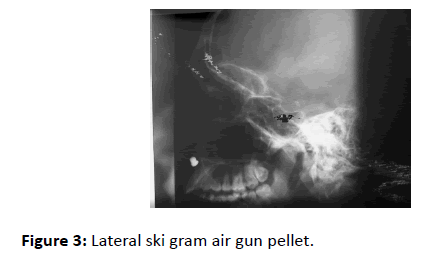 Otolaryngology-gun-pellet