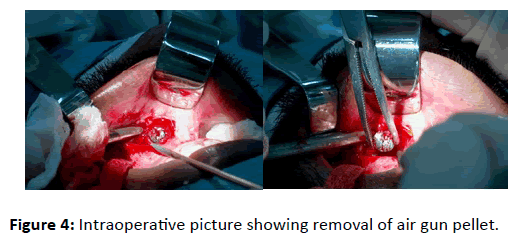 Otolaryngology-gun-removal
