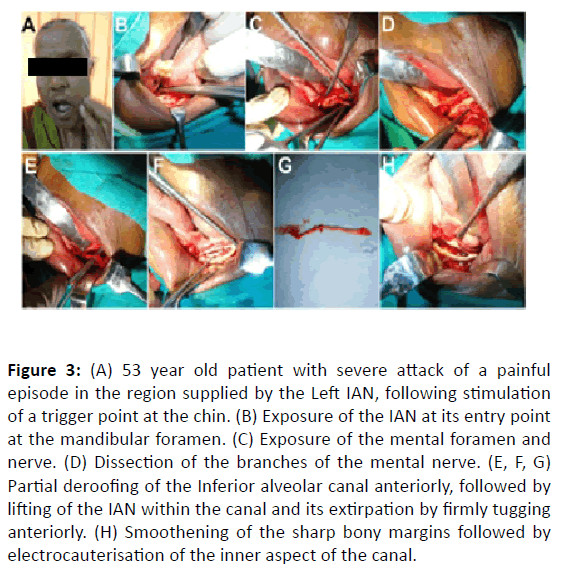 Otolaryngology-inner-aspect