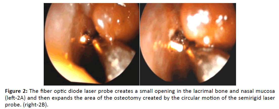 Otolaryngology-lacrimal-bone