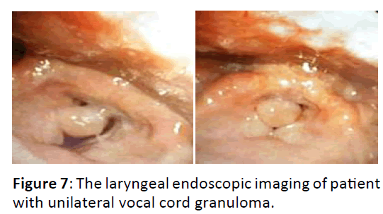 Otolaryngology-unilateral-vocal