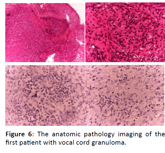 Otolaryngology-vocal-cord-granuloma