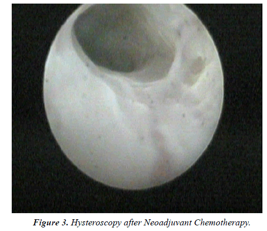 Surgical-Research-Hysteroscopy-Neoadjuvant