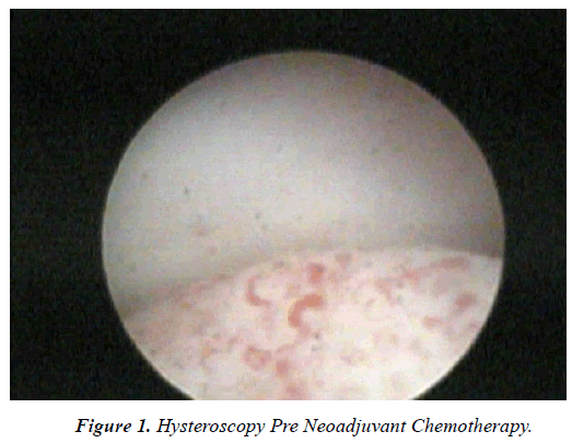 Surgical-Research-Hysteroscopy-Pre-Neoadjuvant