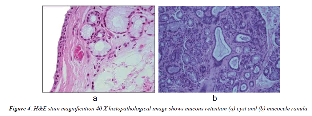 advanced-surgical-mucous-retention