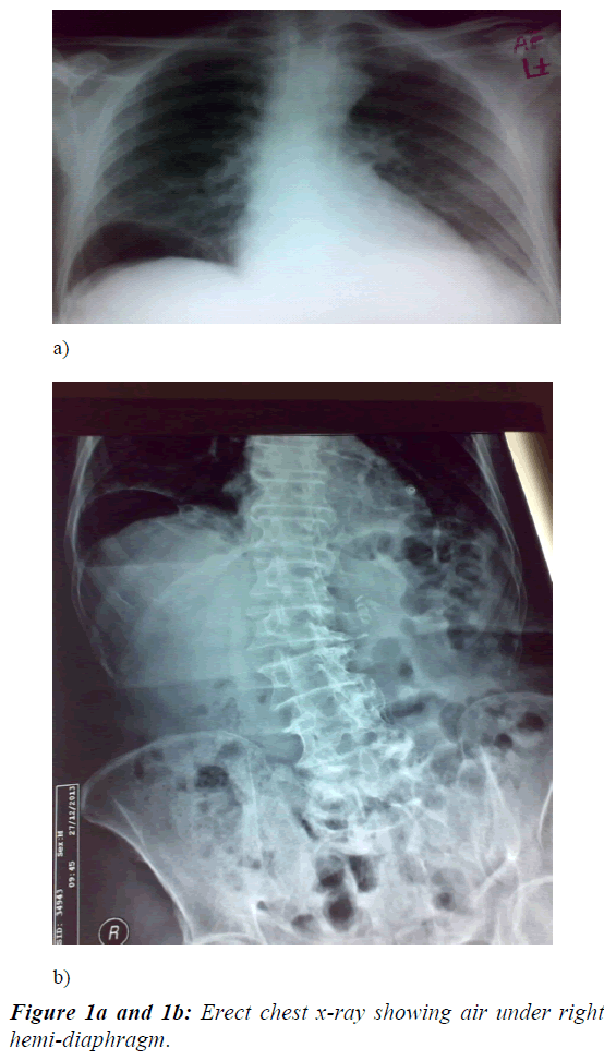 advanced-surgical-research-chest-x-ray