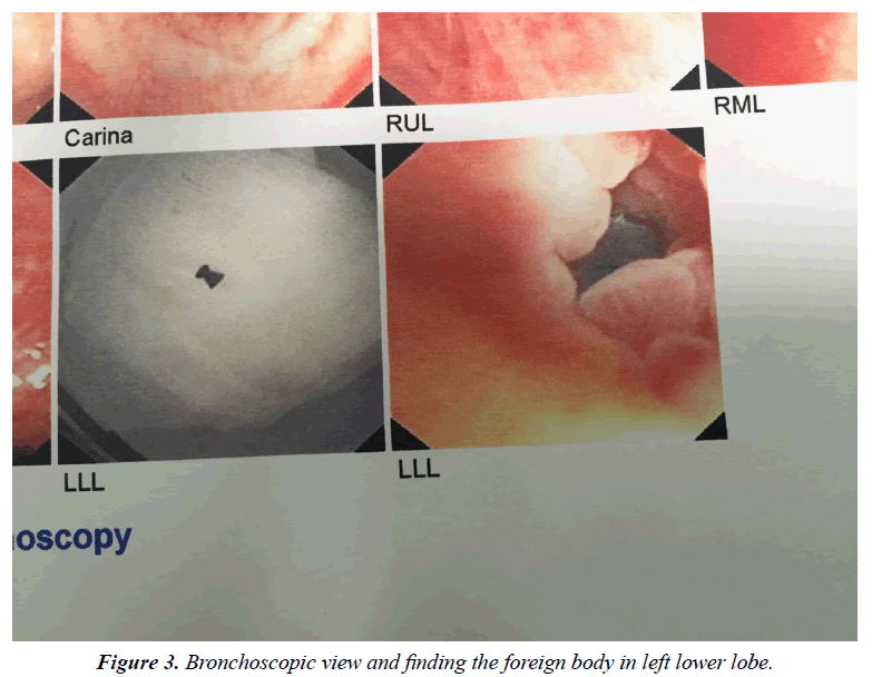 annals-cardiovascular-Bronchoscopic-view