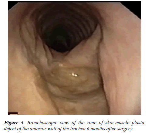 annals-cardiovascular-Bronchoscopic-view