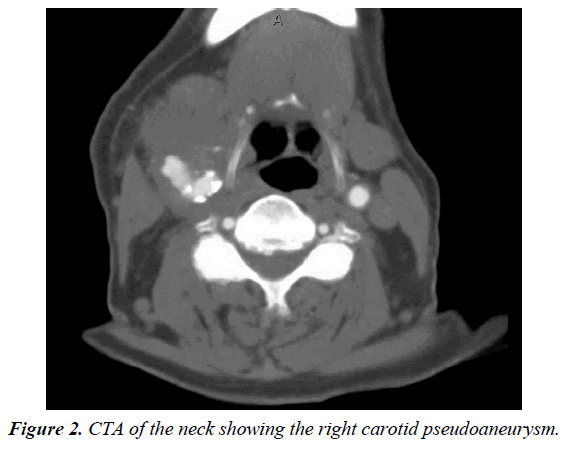 annals-cardiovascular-CTA-neck