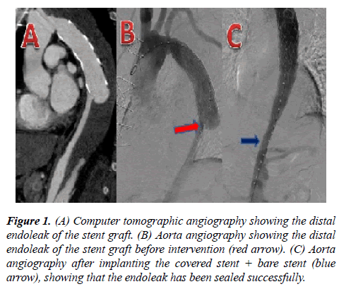 annals-cardiovascular-Computer-tomographic