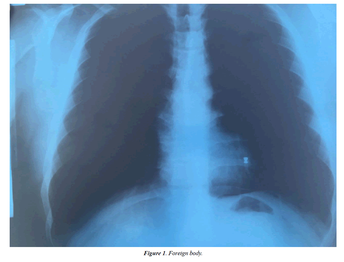 annals-cardiovascular-Foreign-body