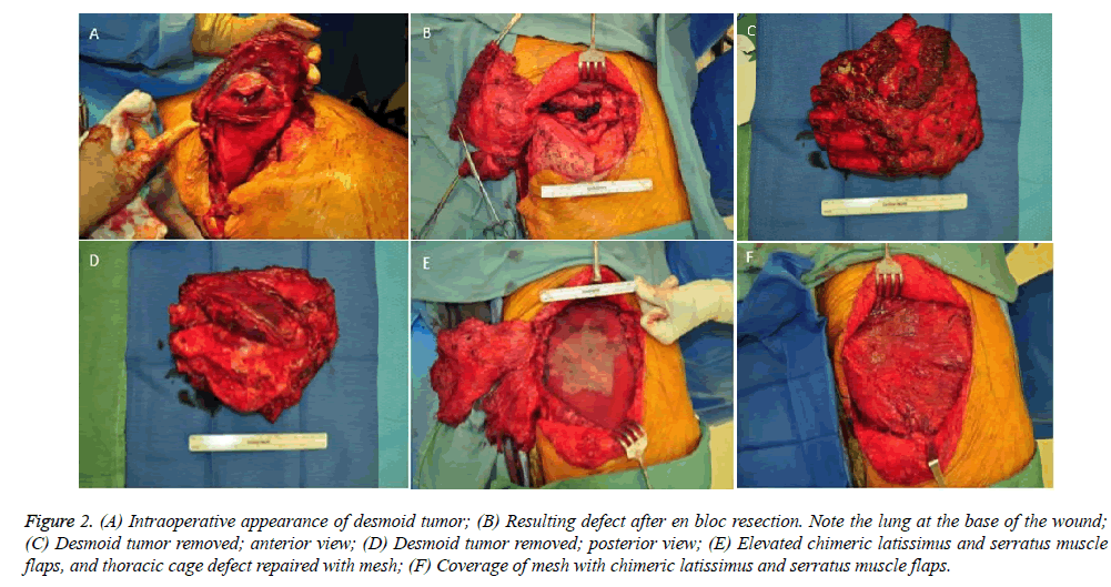 annals-cardiovascular-Intraoperative