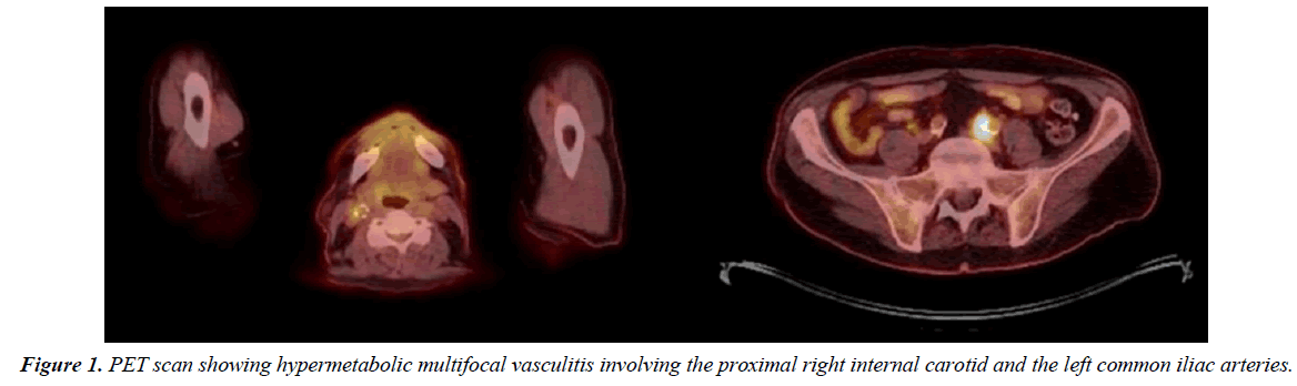 annals-cardiovascular-PET-scan