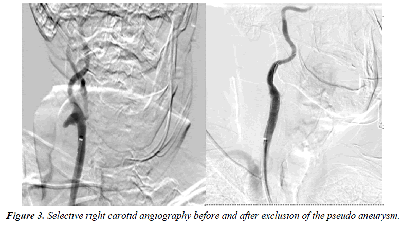 annals-cardiovascular-Selective-right