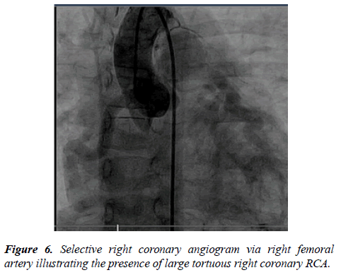 annals-cardiovascular-Selective-right