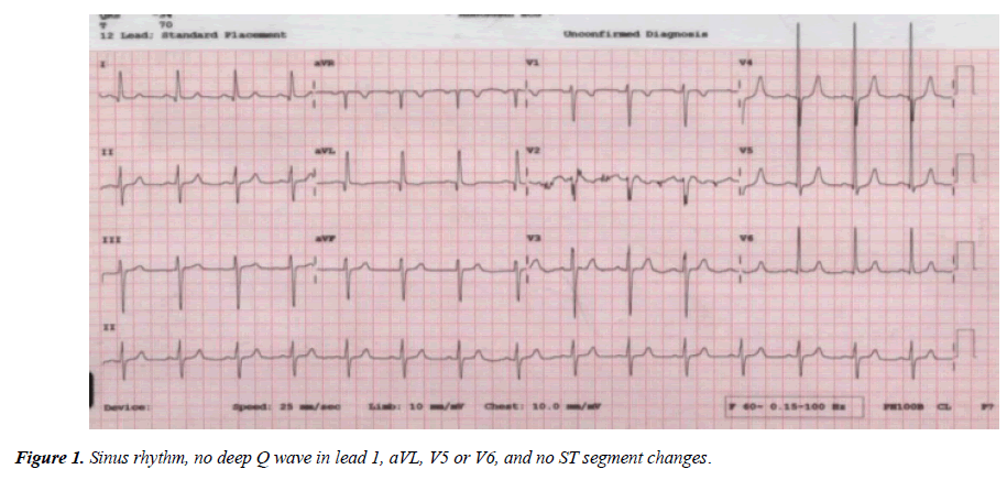 annals-cardiovascular-Sinus-rhythm