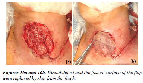 annals-cardiovascular-Wound-defect