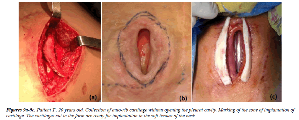 annals-cardiovascular-cartilages-cut