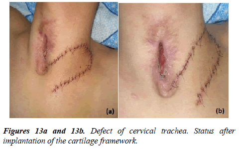 annals-cardiovascular-cervical-trachea