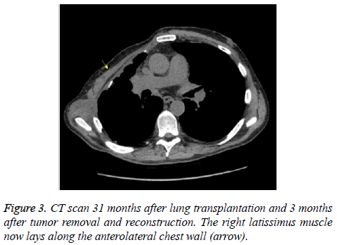 annals-cardiovascular-chest-wall