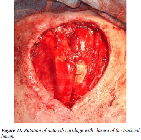 annals-cardiovascular-closure-tracheal